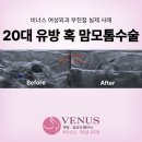 비너스여성외과의원 | 20대 유방 혹 맘모톰 제거 후기 | 비너스 여성외과 부천점 실제 사례