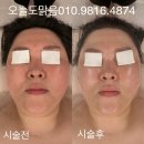 포천 송우리 피부관리 후기 좋은 곳 (+얼굴라인 관리)