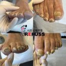 레푸스서초교대역점 | 서초 문제성 발톱 관리, 레푸스 서초교대역점 실제 개선 사례 (전 후 차이 확실합니다!)