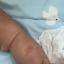 성구농장 | 모기알러지 병원후기, 입는모기장옷, 리도맥스 에스로반 차이