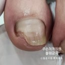 서래의료기 네이버블로그