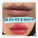 수포차 | 입술문신 1~7일차 리얼 후기 | 붓기·각질·수포 전부 겪어봄