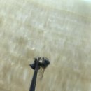 복재신경통 #벌침 직접 맞은 후기 적어봅니다