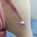 동아제약) 노스카나겔 흉터치료제 내돈내산 후기 (수술흉터주의)