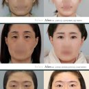 이럴땐 눈밑지방재배치,하안검수술/다른점은?(20대부터 70대까지 선택하는 눈성형)