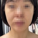 고고성형외과의원 | 우아성형외과 울쎄라 온다리프팅 내돈내산 후기