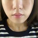 우주사 | 홍대 피부과 콜라겐 부스터 미희주사 팔자 주름관리 후기