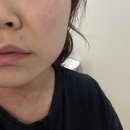 유어의원 | 미금역 유어라인의원 편평사마귀 무제한 제거 및 일주일 경과 후기