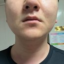부산 서면 성형외과 남자도 관리해야 하는 시대...유니버스로 U 라인에서 V라인이 되다 기본 카메라 후기