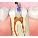 은평장수플란트치과의원 | 구산동치과, 세심한 신경치료 받고 싶다면