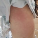 부상보건진료소 | 해외 여행 전 홍역 예방의 모든 것