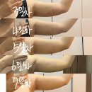 멍우주 | 지팻주사 팔뚝 1주차 후기｜멍,붓기 변화 과정 총정리 (다이어트X, 친구와 비교)