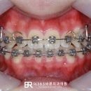 미바른이치과교정과치과의원 | 윗니가 너무 깊게 물려요! 화성시교정치과의 과개교합 교정 이야기
