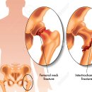 대퇴 골절(Fracture of femur) 이미지