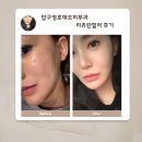 로데오로(1) | 압구정로데오피부과 리쥬란힐러 후기 ( 엠보, 전후사진 )