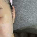 유로성형외과의원 | 내돈내산 편평사마귀 레이저 제거 후기 +실비보험