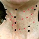 경우 | 목주름 보톡스 내돈내산 후기 어떤 경우에 효과가 없나