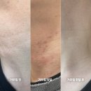 목동은한의원 | 서울 목동 한의원 목 편평사마귀 제거 거우침 한달 후기