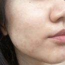 미채 에스테틱 | [강서구 피부관리] 마곡피부관리 미채에스테틱 | 초페리 후기(시간, 주기, 관리)