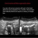 Carcinoma of the sigmoid colon 이미지