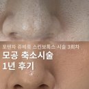 대한광합성 | 모공 축소시술 1년 후기(3) | 포텐자 쥬베룩 스킨보톡스 전후비교 (+과연 효과 유지될까?)