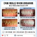 스마일웰치과의원 | 천안 '진짜' 무삭제 라미네이트는 다나웰 치과