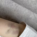 피어랑의원 네이버블로그