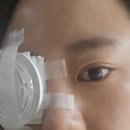 보이다 안경 | 인천 구월동 고도근시 렌즈삽입술 검사부터 수술까지 후기