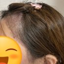 이강연유외과의원 | 내가보려고 자발적으로 쓰는 여성헤어라인 모발이식, 병원 결정 과정과 경과
