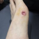 참정형외과의원 | 분당 미금 본닥터 정형외과 결절종 제거 내돈내산후기