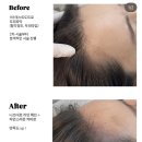 대구 헤어라인 커버 내돈내산 후기 좋은곳 클로이스칼프smp