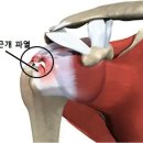 밤에 더 심한 어깨통증 이미지