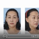 키다리성형외과의원 | 키다리성형외과 후기로 알아보는 50대 동안 얼굴 변화