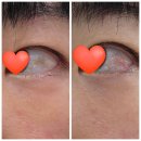 탑플러스안과의원 | 눈알점빼기 흰자점제거 결막모반제거 광명탑플러스안과의원