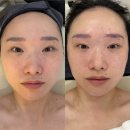 25 | 대구 송현동 윤곽탄력관리 혜윰스킨케어에서 이중턱 올클리어한 후기