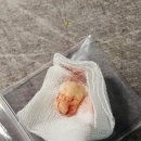 서울뿌리깊은치과의원 | [구강]사랑니 발치 후기(사진주의)