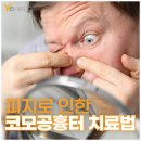 호산한의원 | 피지로 인한 코모공흉터, 선릉역 한의원에서 치료받을 수 있을까?