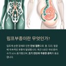 림프부종, 부기에서 수술까지: 조기 진단과 치료 전략