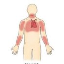 협심증 초기증상 치료 가슴 통증 변이형협심증 이미지