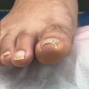 무전성 | 연수동내성발톱 네일젤이뻐 내성발톱