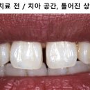 라미네이트치료-무삭제라미네이트, 최소삭제라미네이트,최적의 삭제 라미네이트
