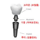 춘천임플란트, 수명 10년이 줄어든 이유? [의사 조언]