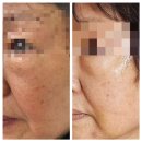 아트뮤지엄 려 | 청담동 피부과 울쎄라 600샷 시술 후기 전후 사진, 엄마 리프팅 받고 왔어요!