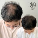 모델헤어라인 - 완주군 | 부산두피문신 옆모습 헤어라인 고민 상담 에테르노 후기