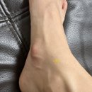 서울병원 | 부주상골증후군 SNU 서울병원 수술 후기(비수면마취, 입원준비물, 4인실)