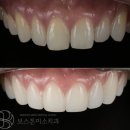 미소치과기공소 | 의정부 보스톤미소치과 아래 치아가 삐뚤어서 고민이셨다면, 라미네이트로 자연스럽게 정리