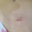 연세백비뇨기과 | [25개월 남아] 음낭수종 수술 후기(전신마취 / 세브란스 어린이 병원)