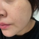 세일병원 앞 | 올영세일 쿼드쎄라 미니튠 일주일 실사용 후기 비포 에프터 비교