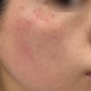 닥터이레이저피부과의원 | 압구정로데오 닥터이레이저피부과의원 시그니처 토닝 - 1~10회 시술 내돈내산 후기 (기미/홍조/색소침착...