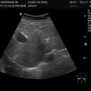 pleural effusion and CRF 이미지